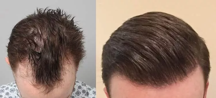 Résultat final et naturel d'une greffe de cheveux après un an.