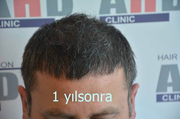 saç ekiminde 1.yıl görüntüsü