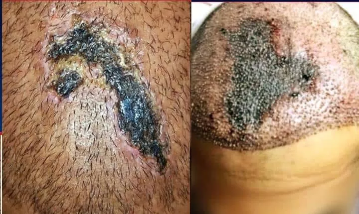 Identification des signes de nécrose (complication rare).
