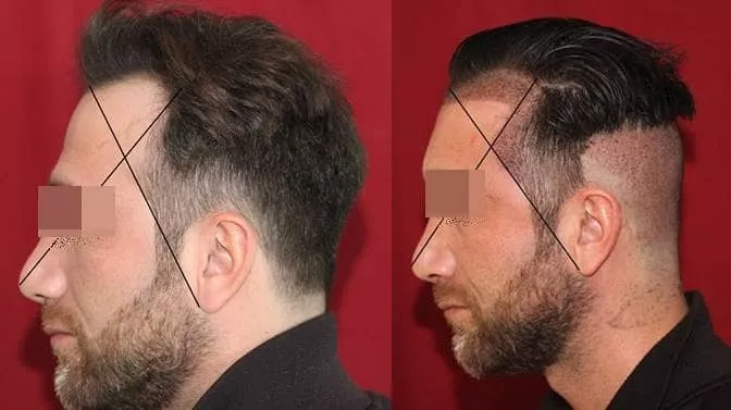 greffe cheveux tempes