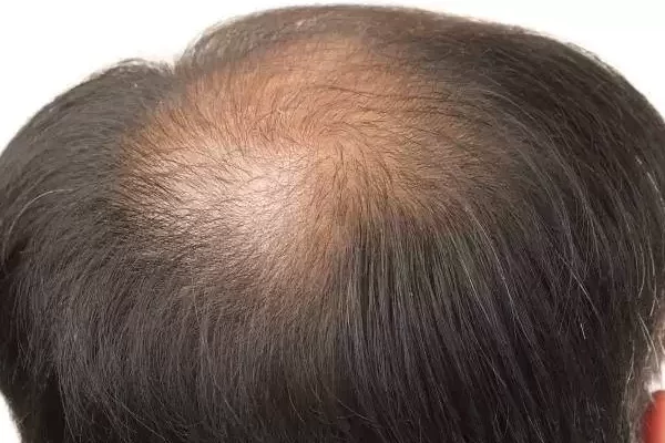 greffe cheveux vertex