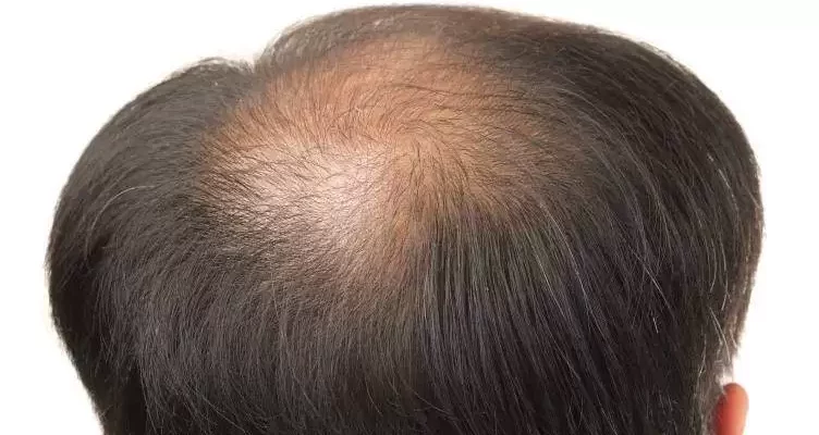 greffe cheveux vertex