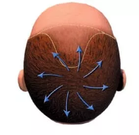 implant capillaire vertex