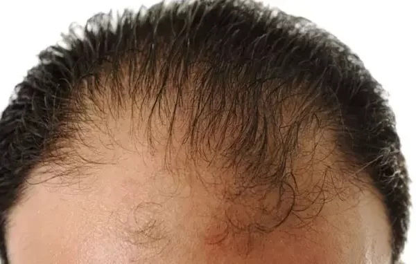 chute de cheveux après greffe