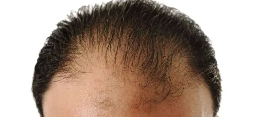 chute de cheveux après greffe
