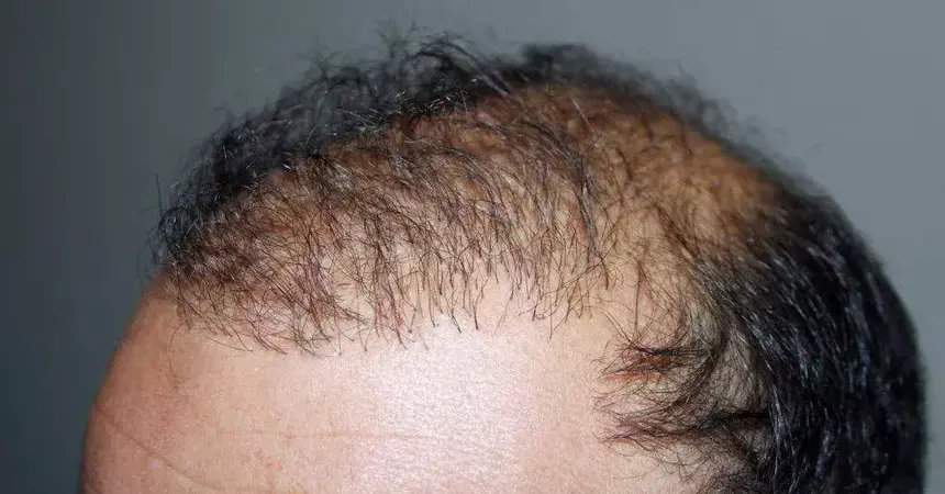 quels sont les risques d une greffe de cheveux