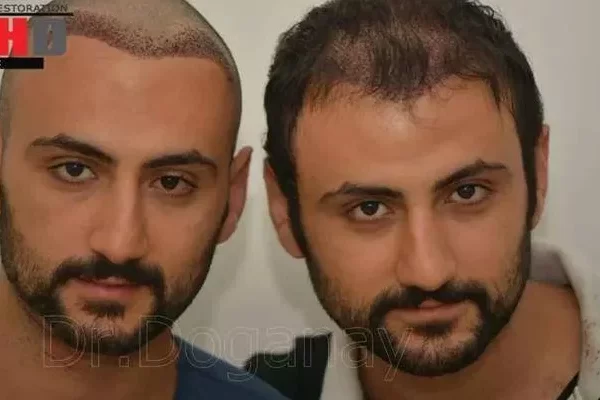 Greffe de cheveux issue d'un donneur tiers