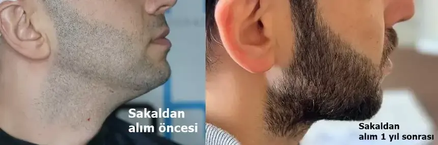 Donneur de barbe avant et après.