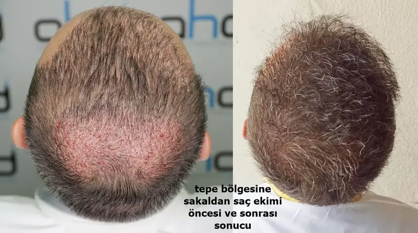 Greffe de cheveux de la barbe au vertex