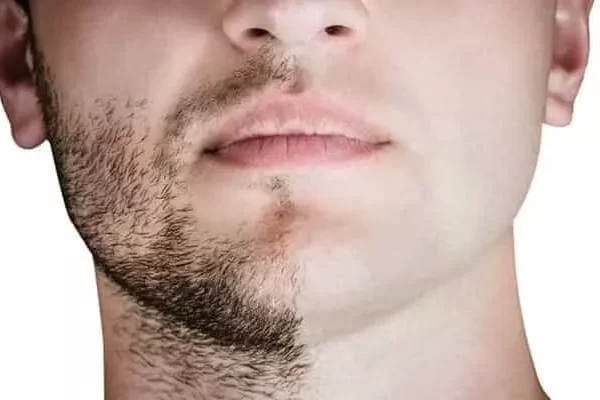 greffe de cheveux à partir de la barbe