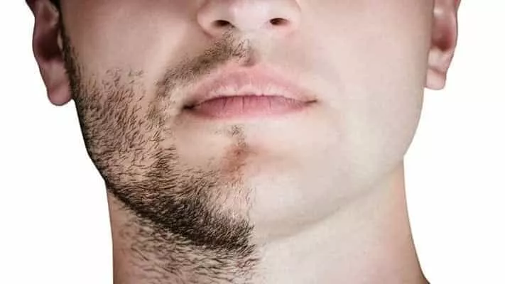 greffe de cheveux à partir de la barbe
