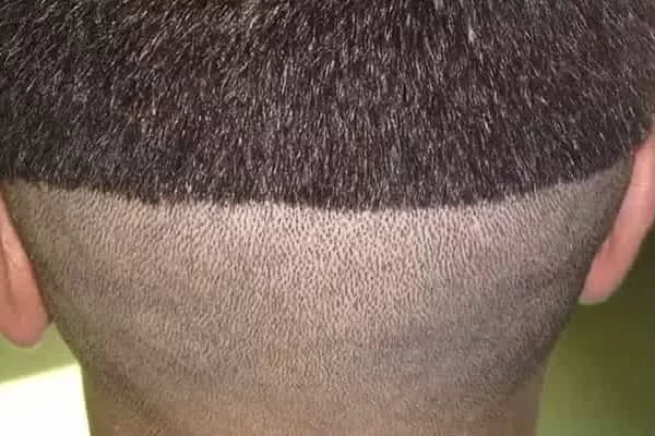 greffe fue sans rasage