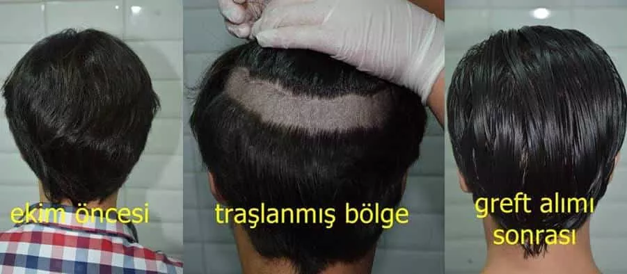 greffe cheveux sans rasage turquie
