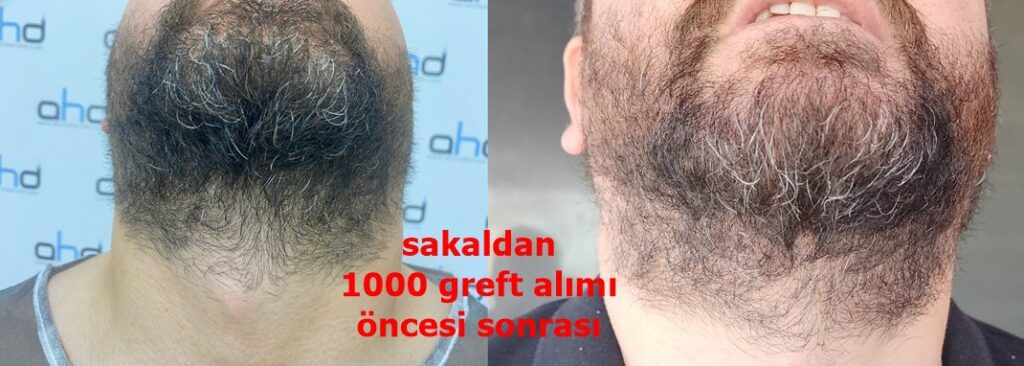 saç ekiminde sakal kullanımı