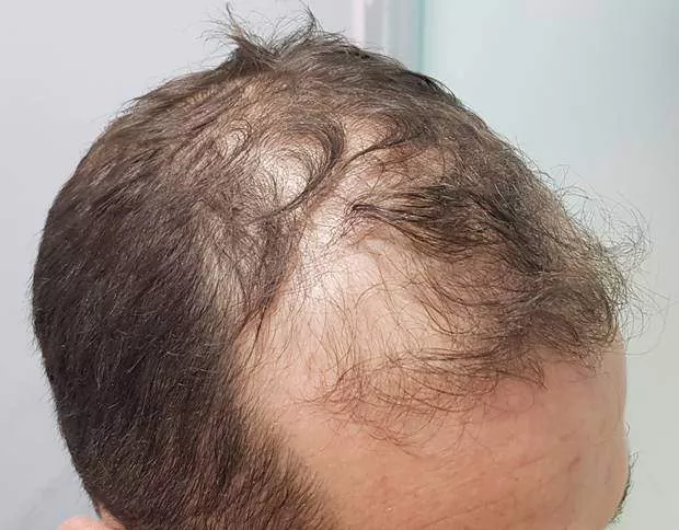 3000 grafts before right side