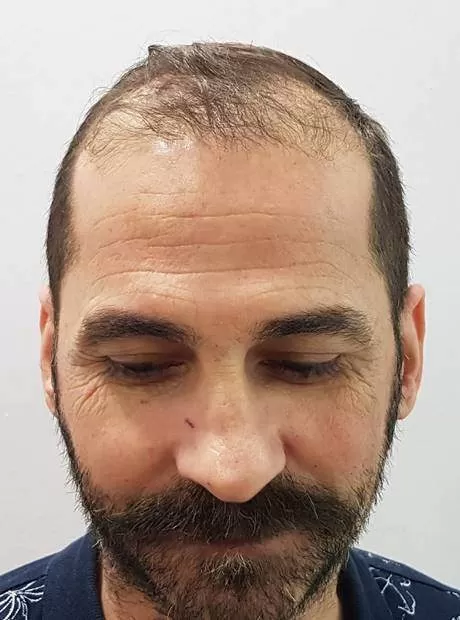 before hair transplant 3000 grafts