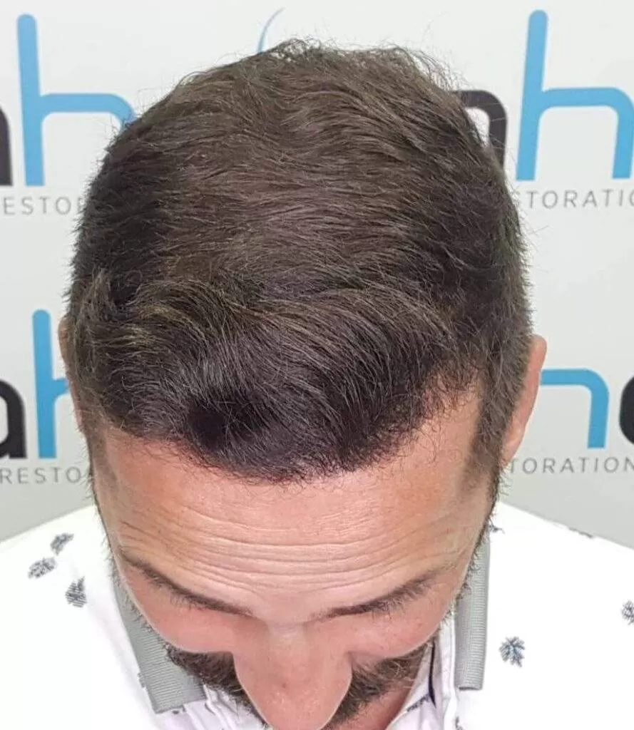 3000 grafts hair transplant top