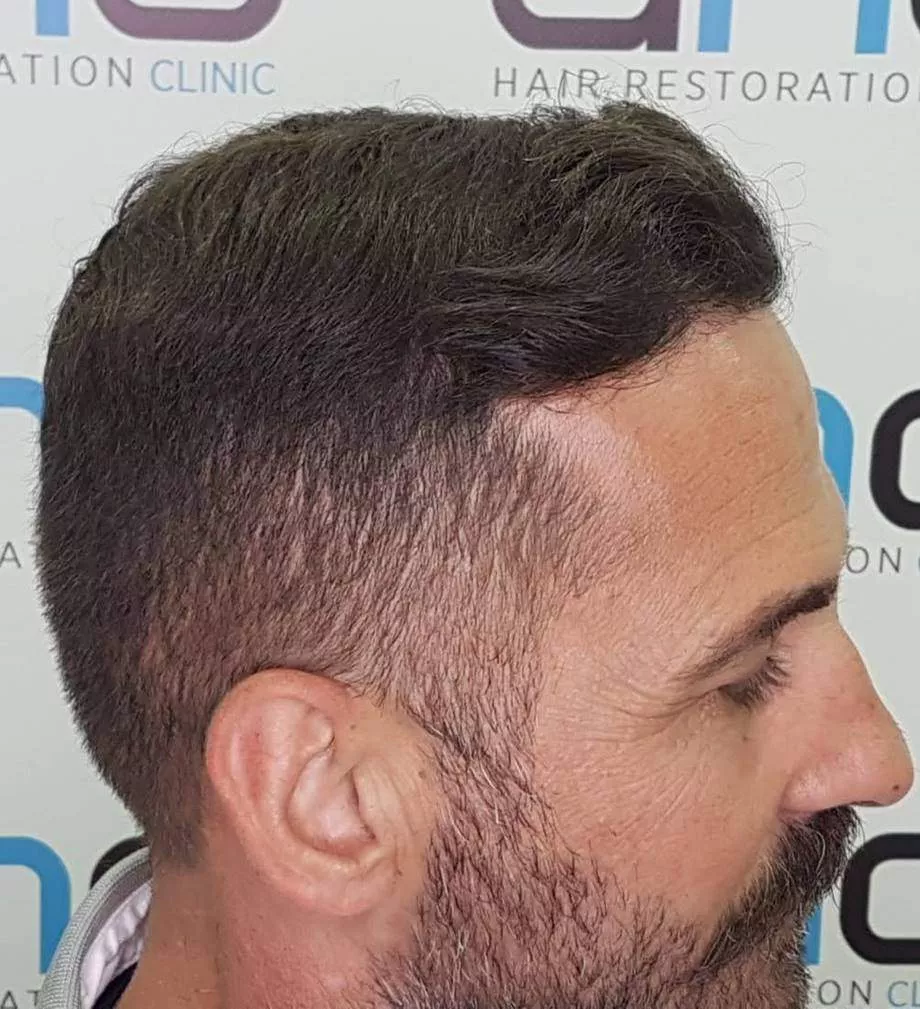 3000 grafts hair transplant right side