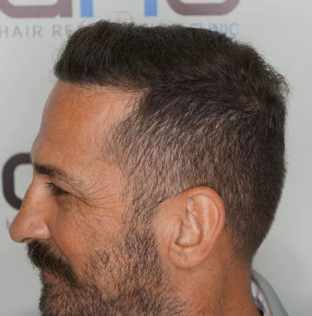 3000 grafts right side