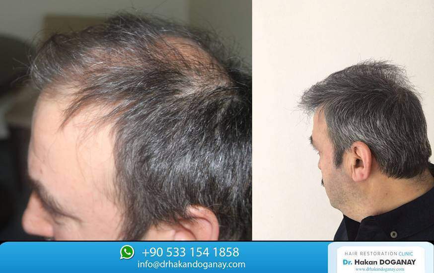 New Roots Skin, Laser & Hair Transplant Clinic - Hair transplantation  clinic - Nagpur - Maharashtra | Yappe.in