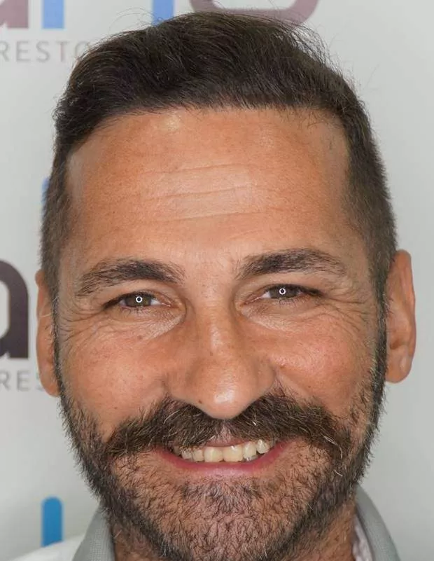 hair transplant 3000 grafts after 7 months