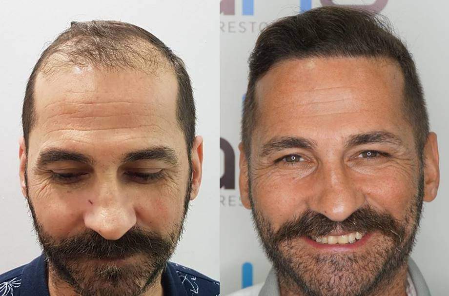 Afro Hair Transplant in Istanbul, Turkey | Updated Prices (2023)