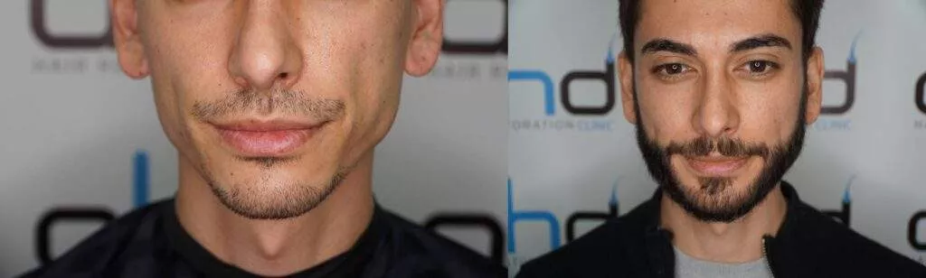 beard implant before after