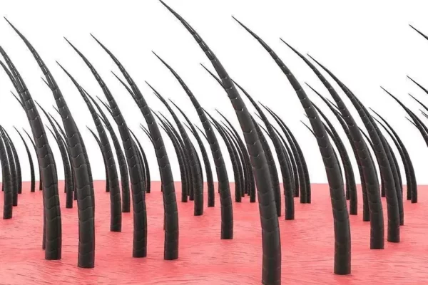 greffe de cheveux fue