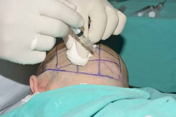 L’application d’une anesthésie locale sur la zone donneuse lors d’une greffe de cheveux FUE.