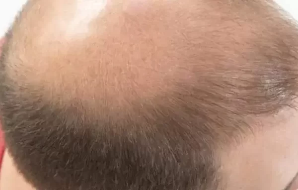 deuxieme greffe de cheveux