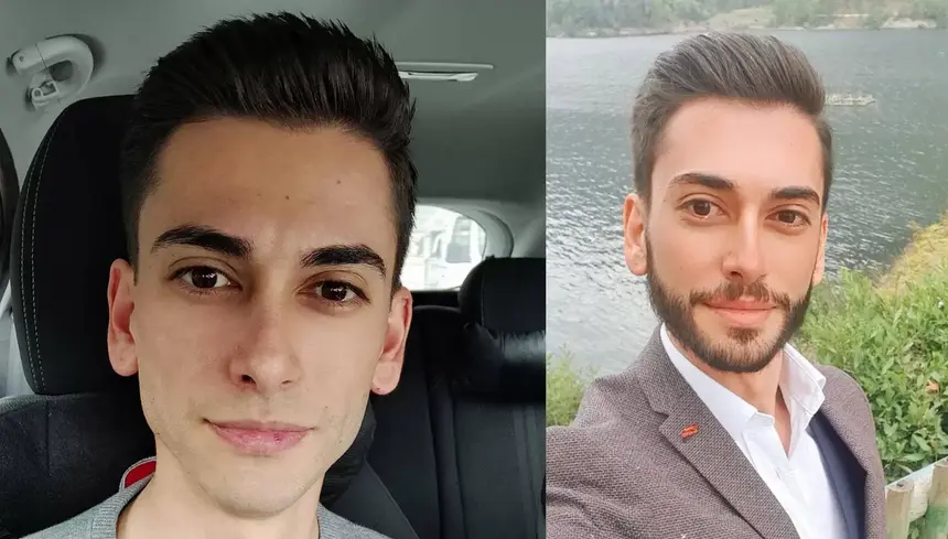 Une transformation qui impacte positivement l'ensemble des traits du visage.