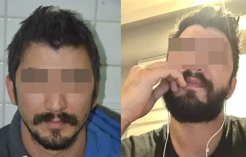 Comparaison avant et après une implantation de poils faciaux.