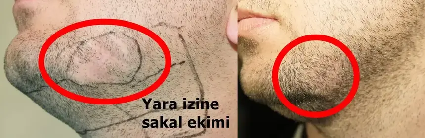 Correction d’une cicatrice par greffe de barbe