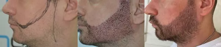 Densification de la barbe après greffe