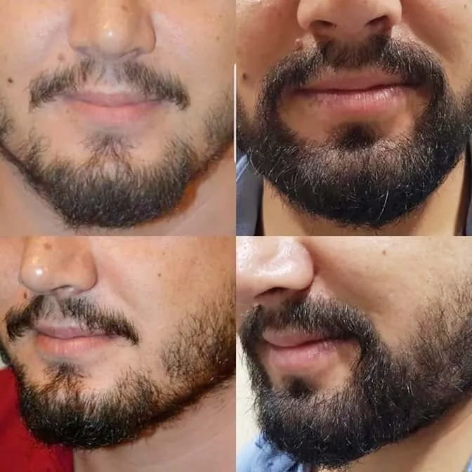 Résultat de greffe de barbe chez un patient masculin