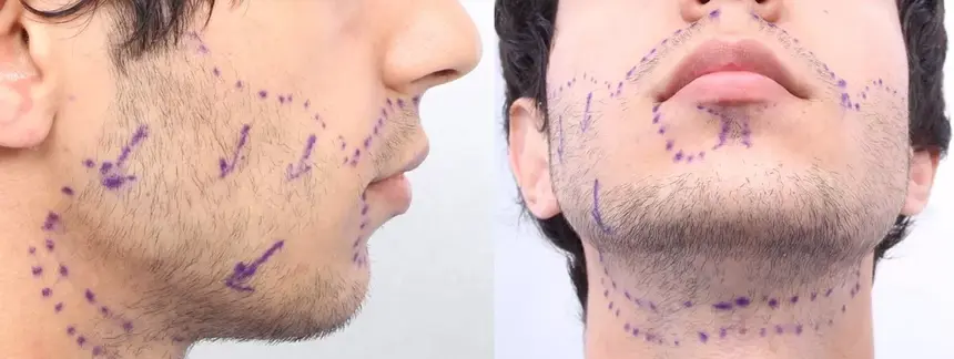 Design de barbe personnalisé pour une structure faciale masculine.