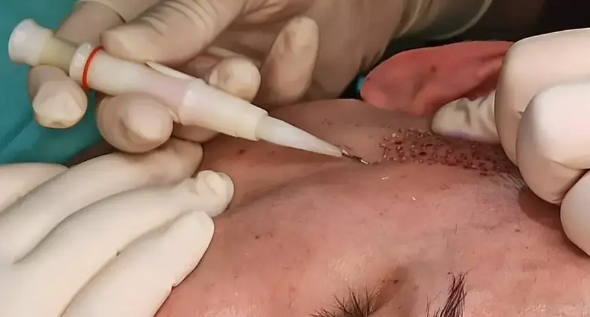 Correction des zones clairsemées de la barbe avec la technique DHI.