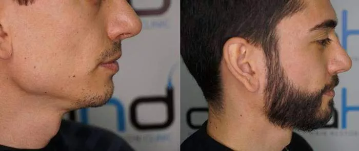 Résultat avant et après une greffe de barbe à la clinique AHD.