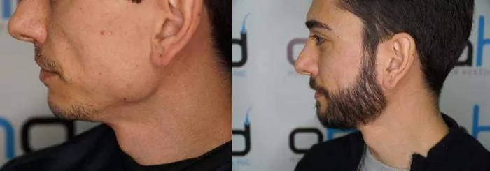 Aspect de la barbe 9 mois après la greffe