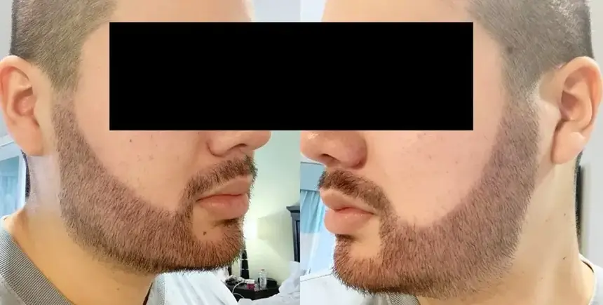 Densité progressive obtenue après la greffe de barbe