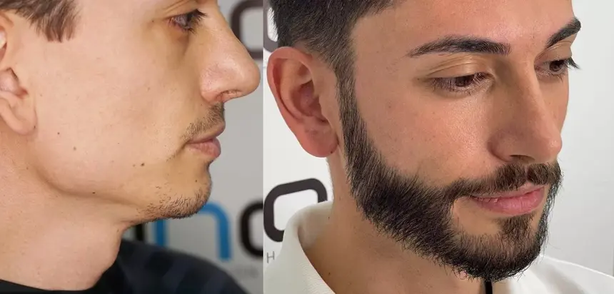 Expertise de la clinique AHD pour une pilosité faciale masculine.