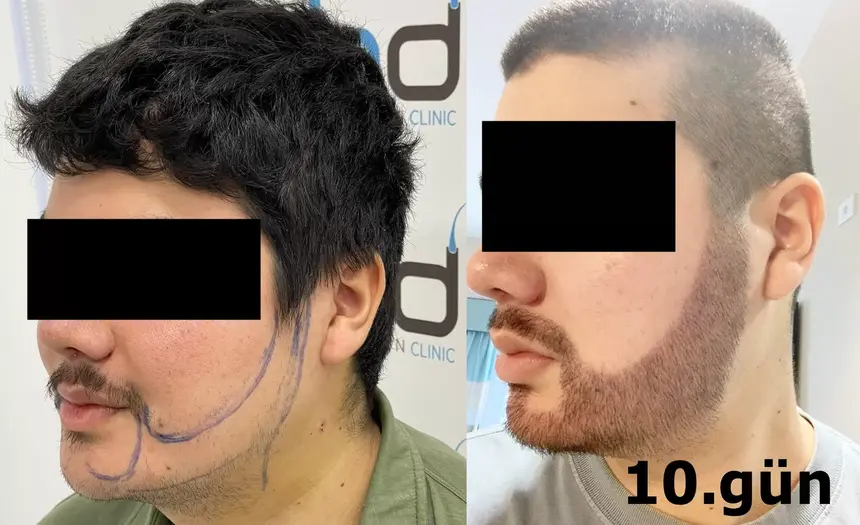Implantation naturelle des poils de barbe
