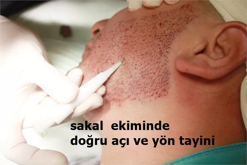 Implantation de poils sur le visage pour un aspect naturel.