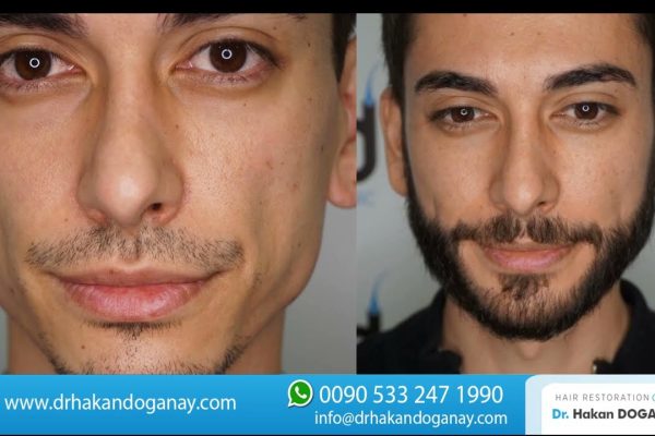 Video Thumbnail: 2800 Grafts Beard Transplant Before and After I Dr. Hakan Doganay TURKEY
