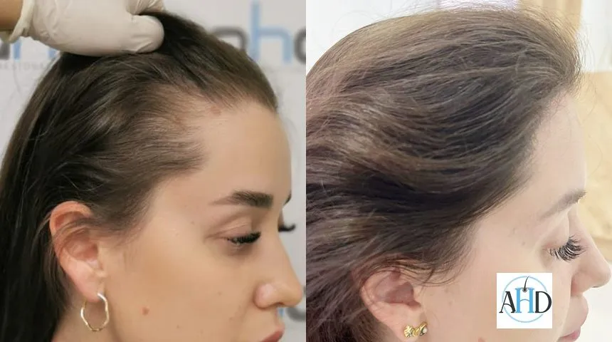 L’incroyable résultat d’une greffe de cheveux chez une jeune femme : avant et 1 an après.