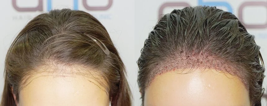Restauration capillaire pour une ligne frontale haute et large chez la femme.