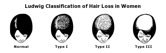Classification de Ludwig pour la perte de cheveux chez la femme